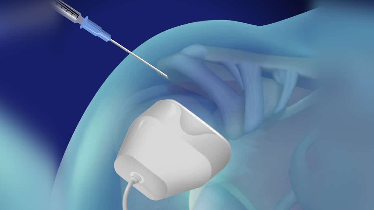 Ultrasound-Guided Injections